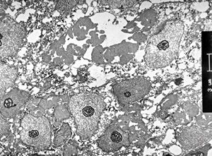 M,61y. | carcinoma - submandibular gland